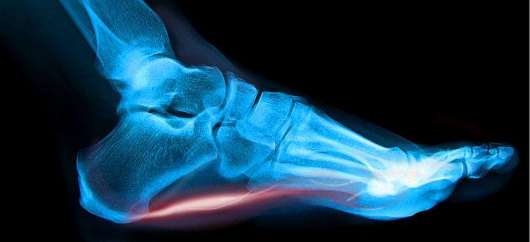 , Tenotomy for Chronic Tendon Pain