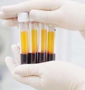 , Platelet-Rich Plasma Therapy (PRP)