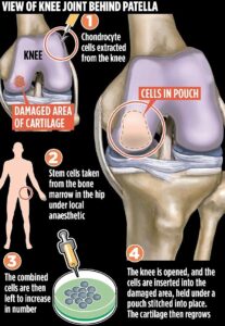 , Ways To Improve Knee Pain