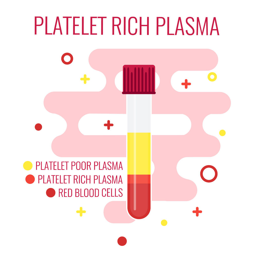 , Platelet-Rich Plasma Therapy (PRP)