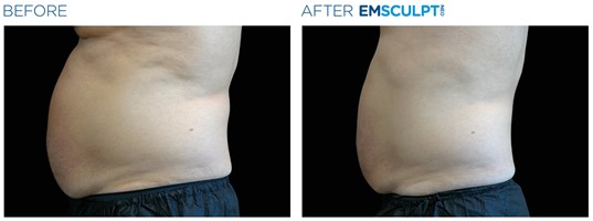 , 33% off Emsculpt NEO for a limited time