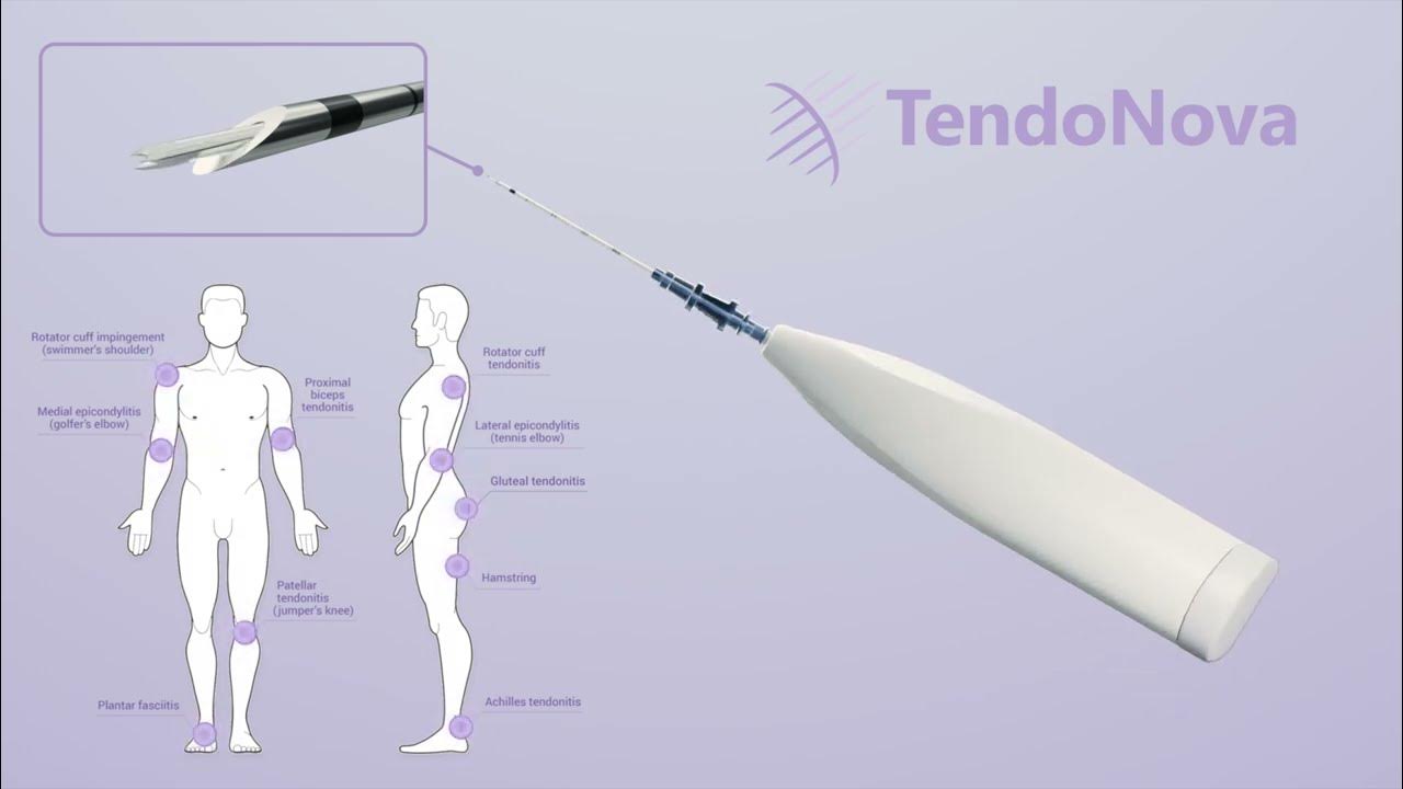 , Tenotomy for Chronic Tendon Pain